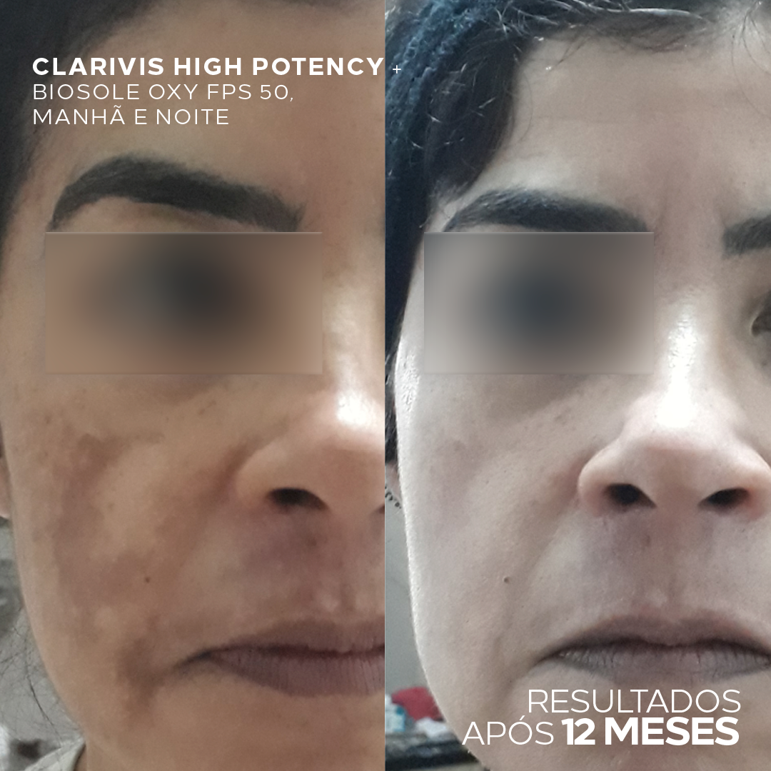 Kit Dermatológico Clareador de Alta Potência Para Pele com Melasma