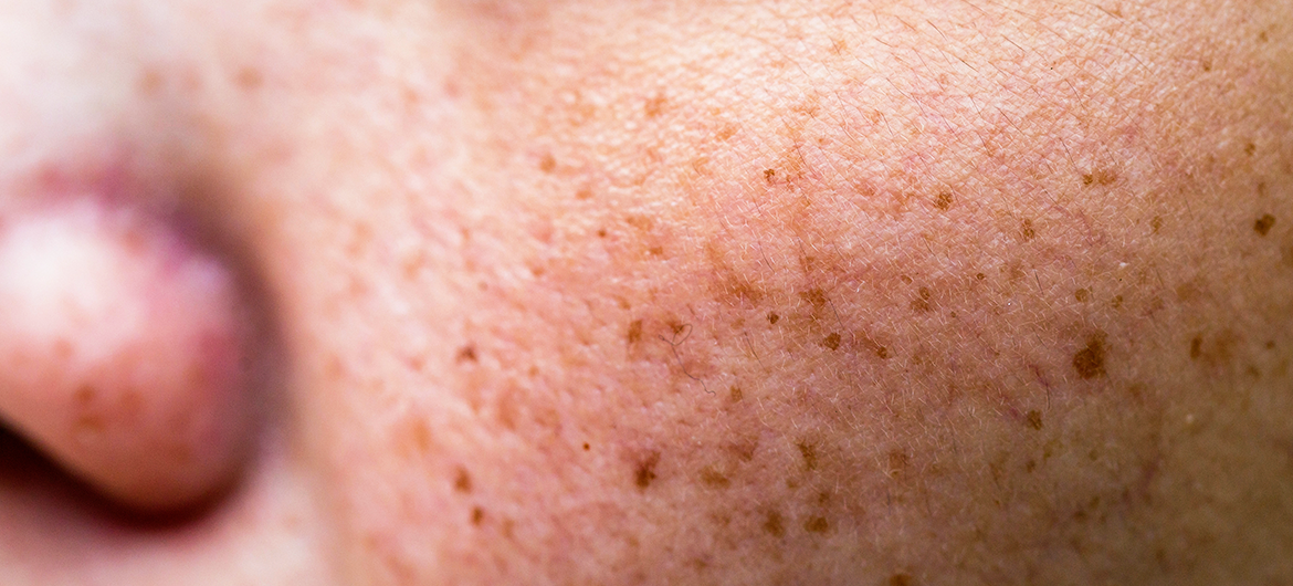 Melasma e Sol: O guia definitivo para proteger sua pele