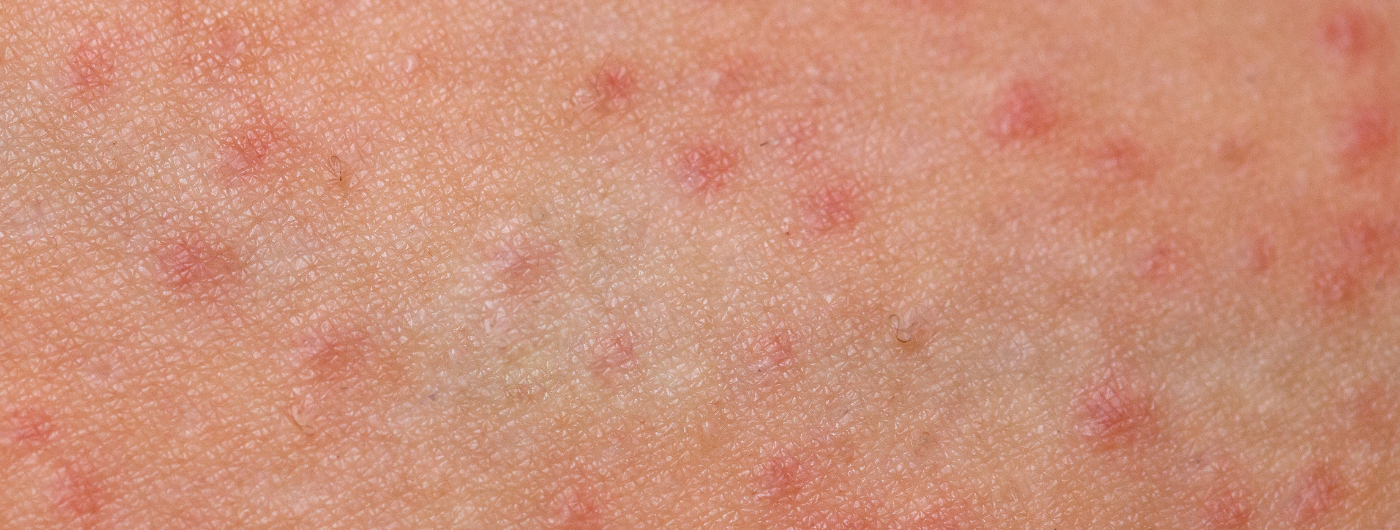 Foliculite: o que é e como tratar?