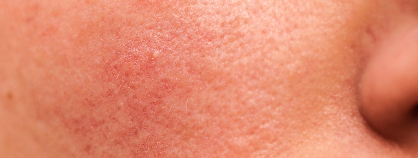 Melasma em pele sensível: Como clarear manchas sem irritação?