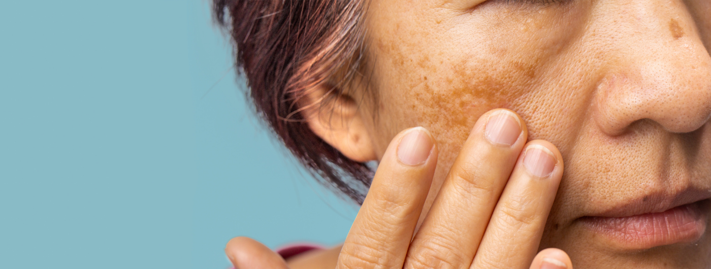 Qual é o protetor solar mais indicado para quem tem melasma