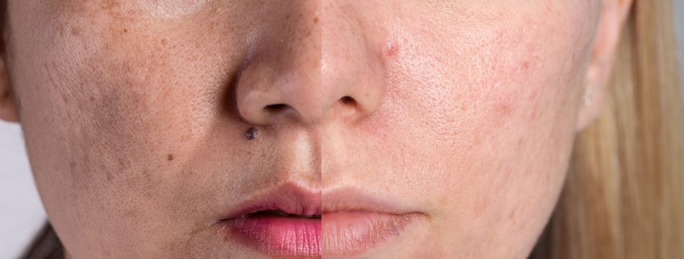 Mancha de acne ou melasma? Aprenda a diferenciar!