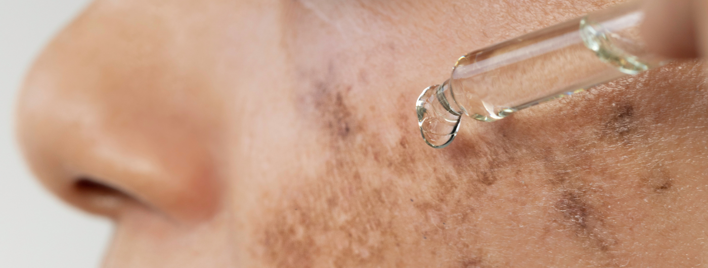 Por que o melasma sempre volta? Saiba tudo sobre o efeito rebote!