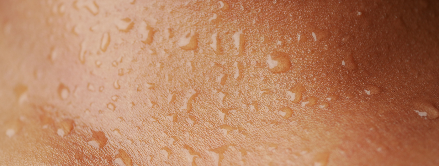 Pele oleosa no calor: por que piora no verão?