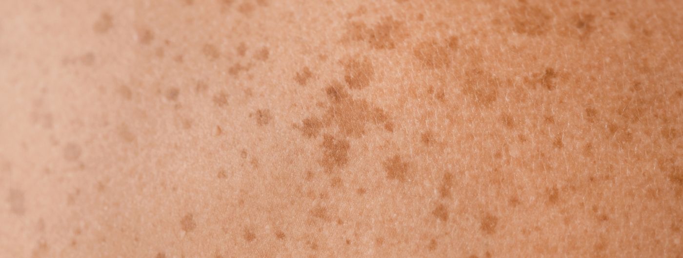 Melasma é hereditário? Entenda a influência da genética e do sol nas manchas escuras
