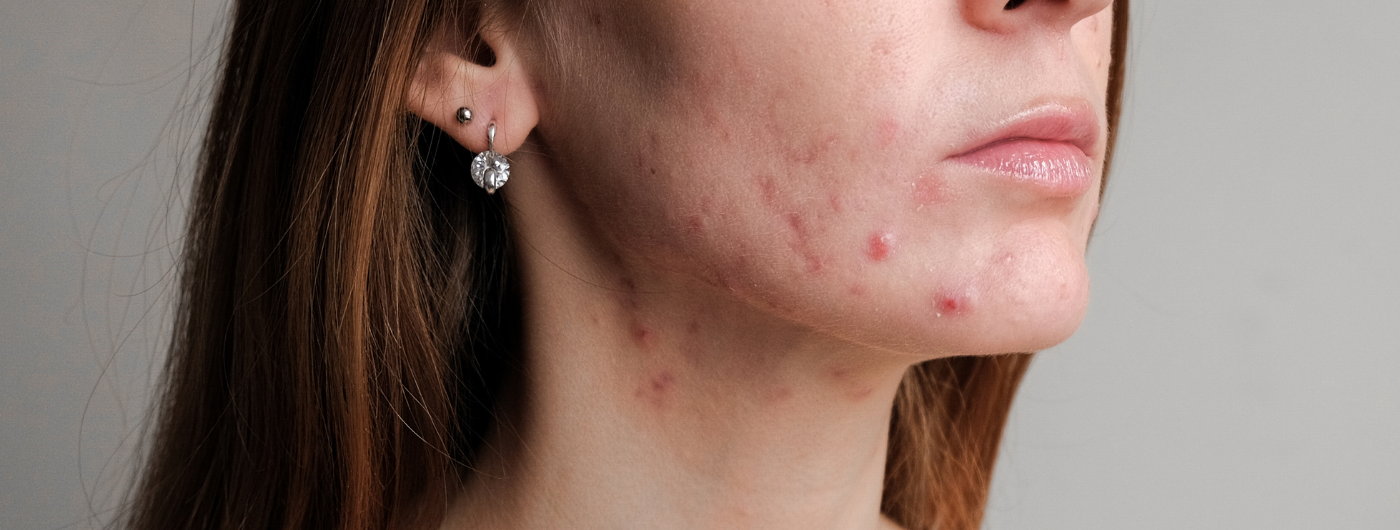 Quem tem pele oleosa tem mais espinhas?