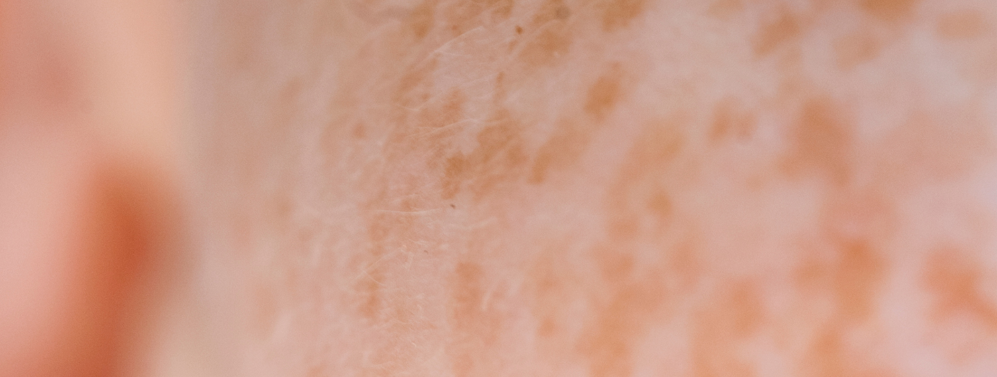 Melasma pode espalhar? Entenda a evolução das manchas na pele do rosto