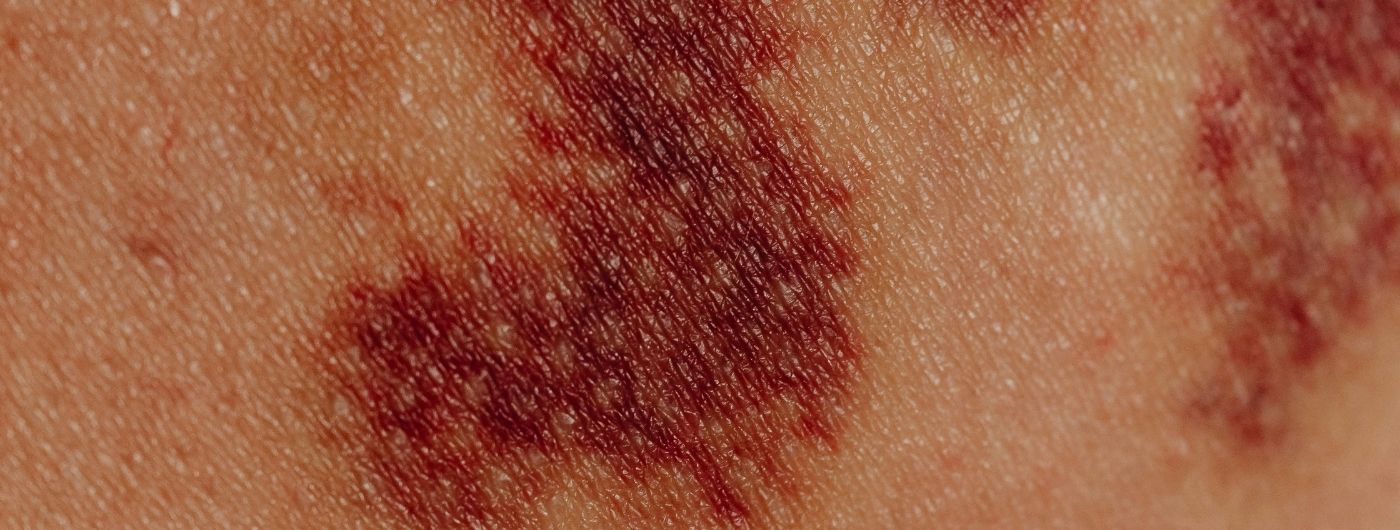 Melasma tem tratamento definitivo?