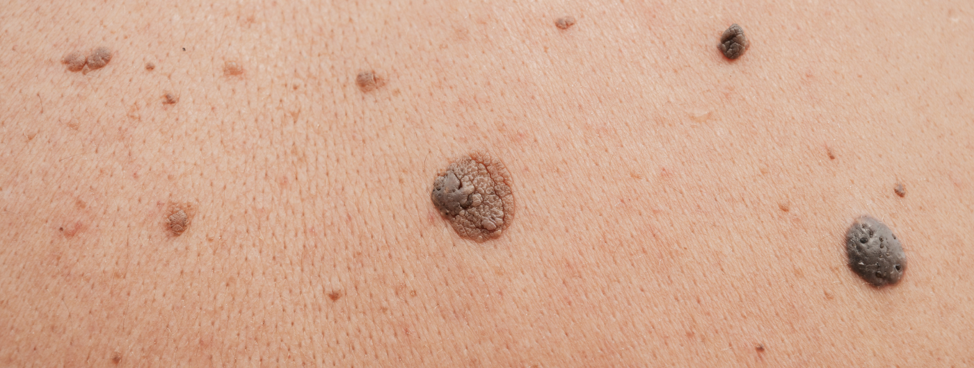 Como identificar o câncer de pele? Conheça o método ABCDE