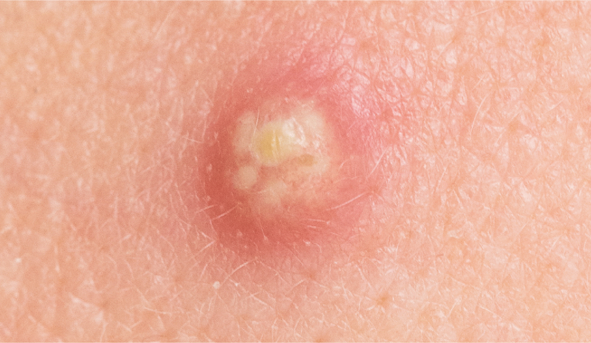 Bolinhas na testa são espinhas?