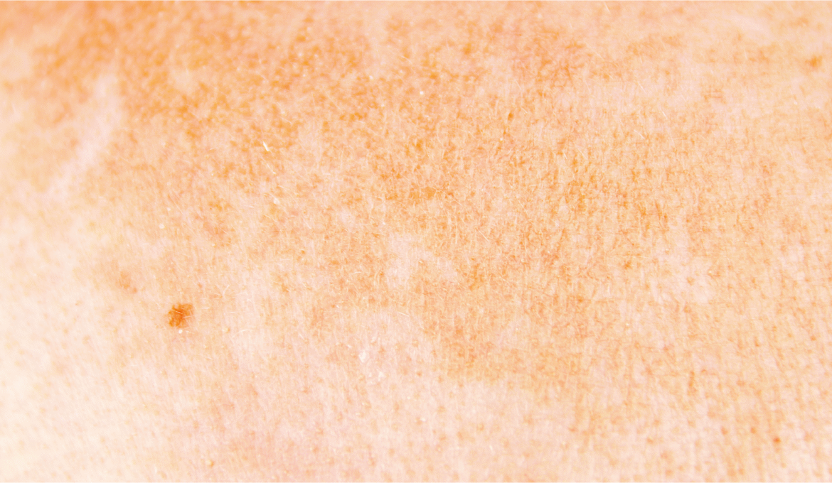 Tudo sobre Melasma: Guia Completo 2026