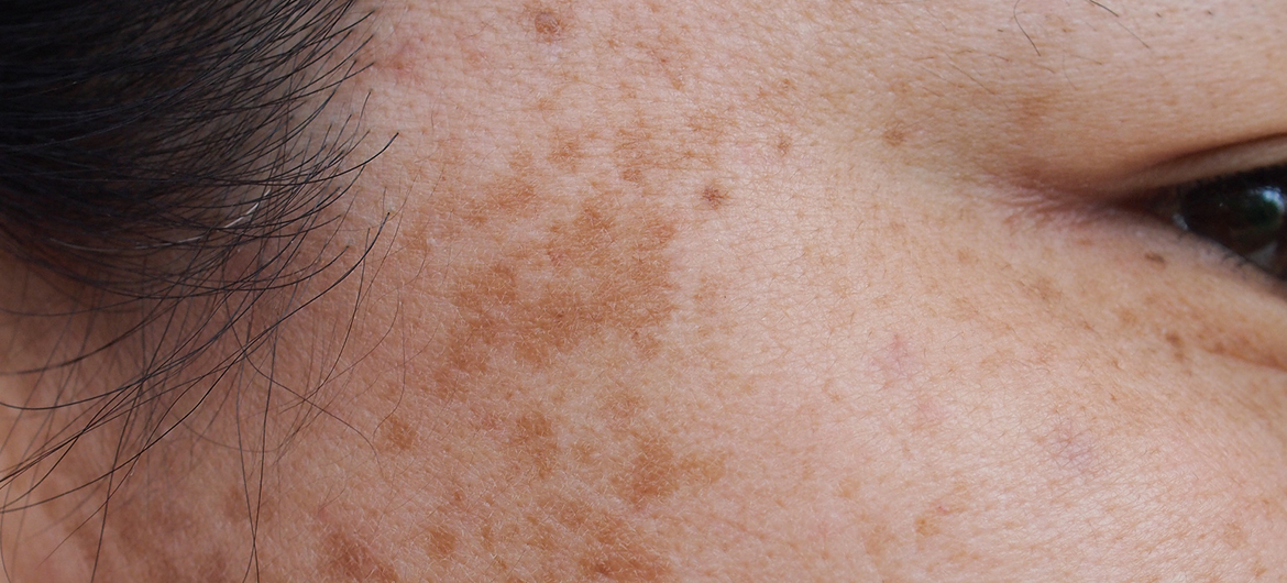 Melasma tem tratamento? Como clarear o melasma da pele!