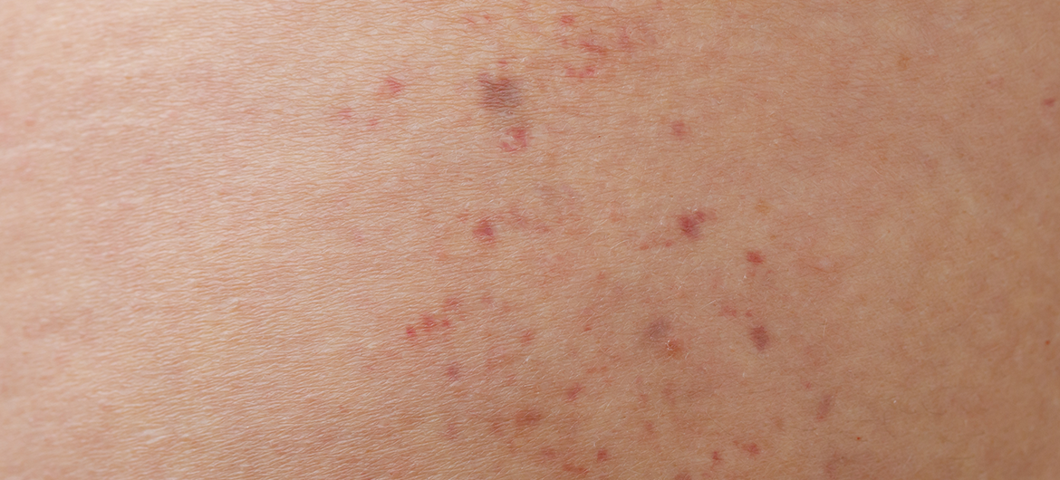 Manchas de dengue: como identificar e quais cuidados ter?