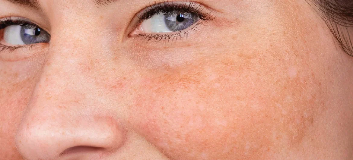 O que causa melasma? Saiba tudo sobre essa mancha!