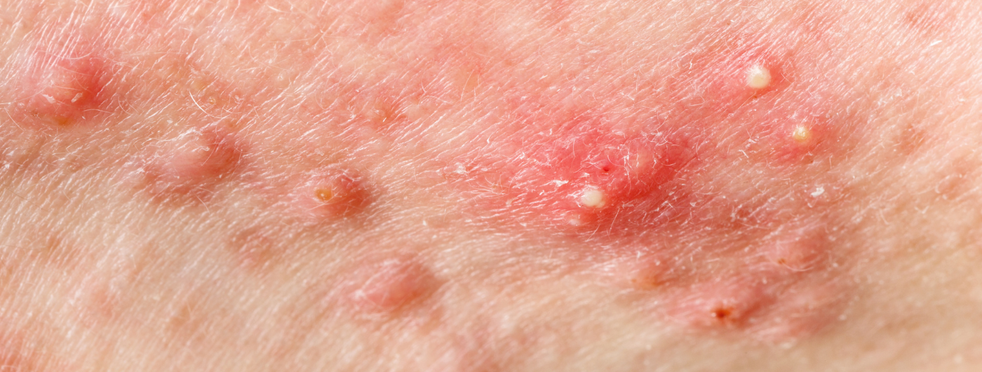 3 sinais de que você está exagerando nos produtos para espinhas