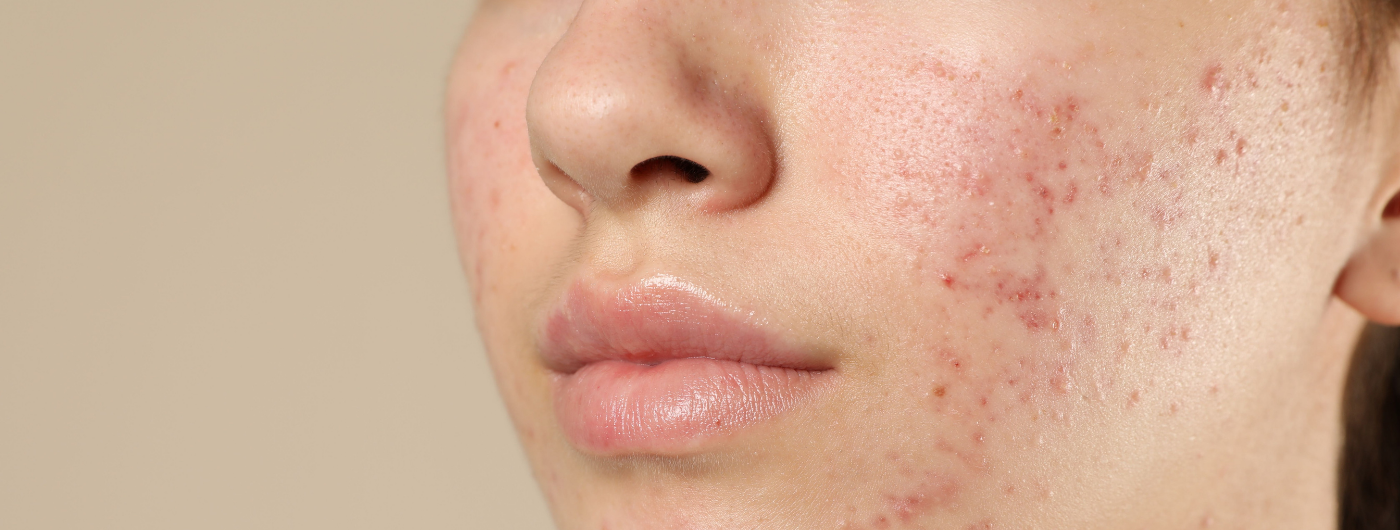 Ácido Azelaico vs. Ácido Salicílico: qual o melhor para desinflamar espinhas e controlar o sebo?