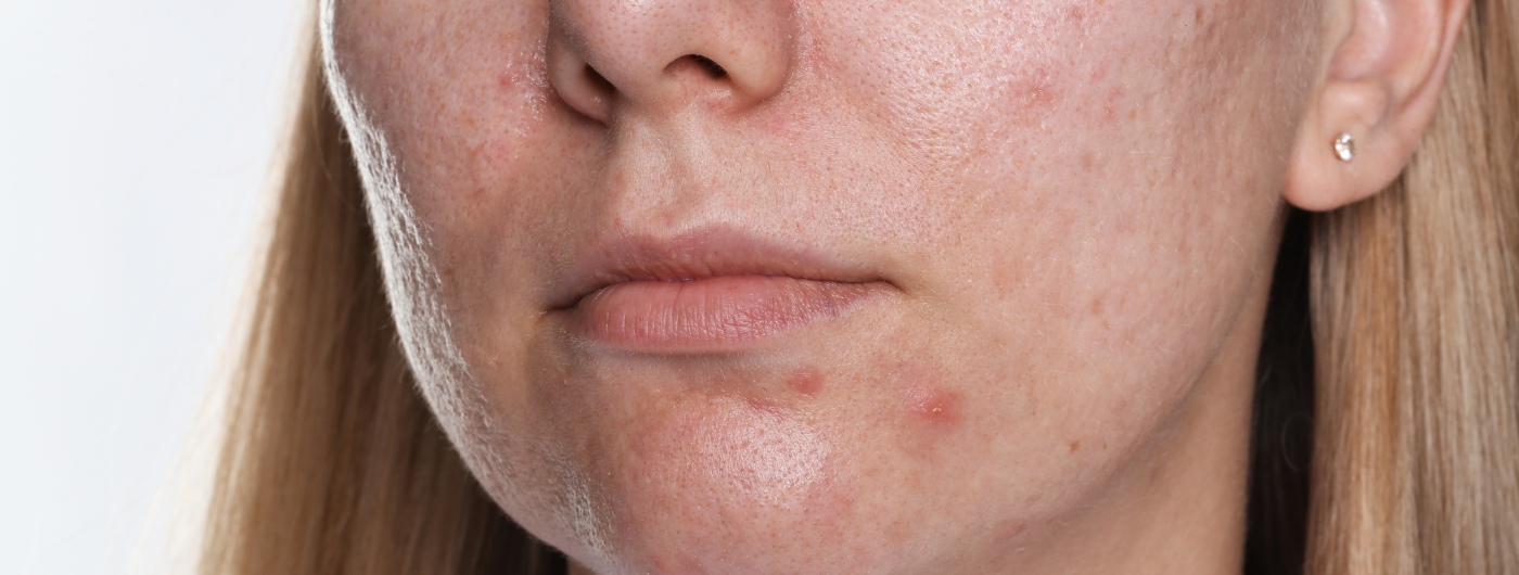 Acne Adulta: por que ocorre e como melhorar?
