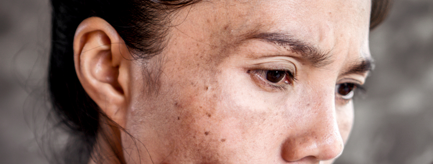 7 erros para evitar ao clarear manchas