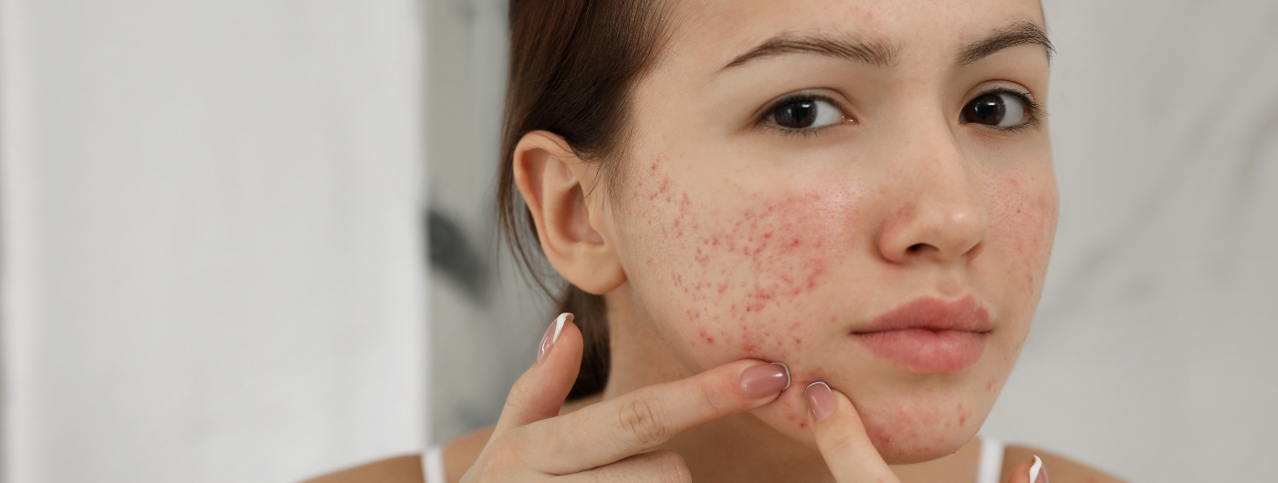 Ácido Azelaico ou Ácido Salicílico: qual é melhor para acne?