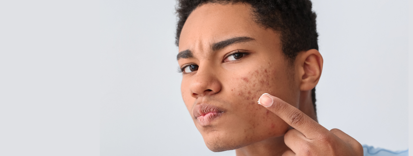 Ácido azelaico para acne: como funciona e como usar?
