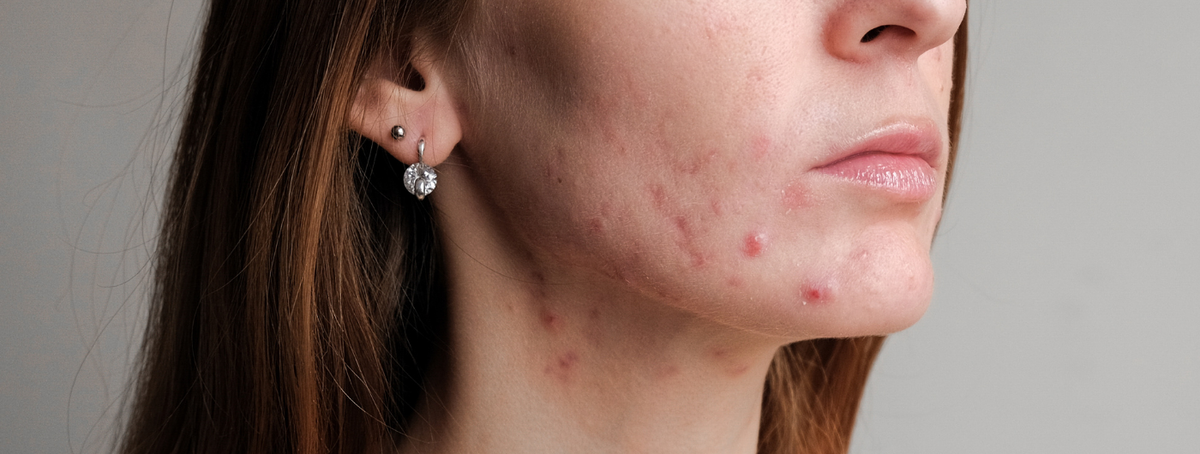 Acne adulta feminina: causas, cuidados e rotina de skincare