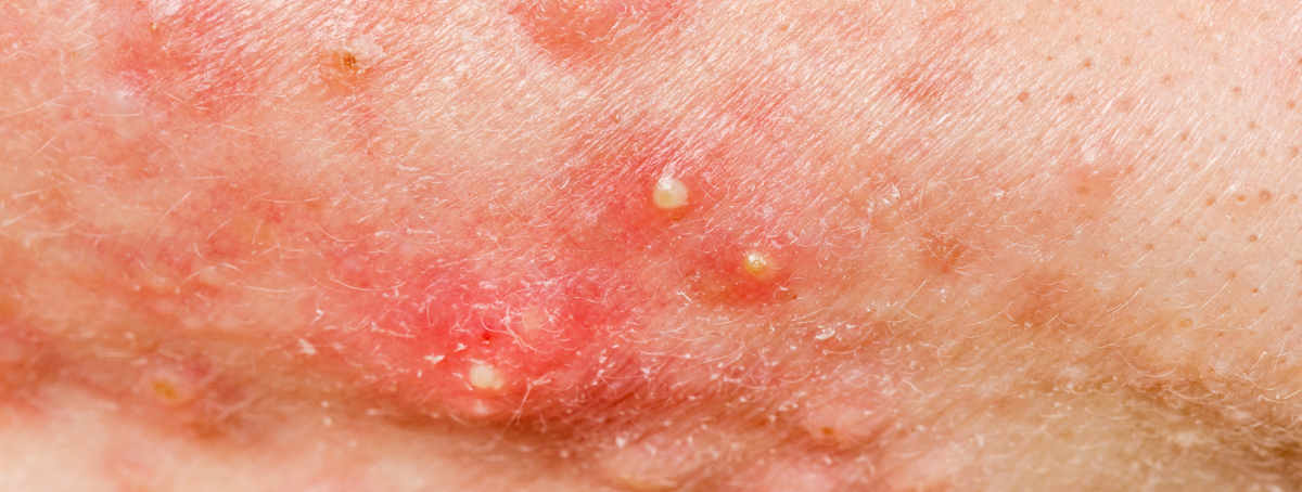 Acne fúngica vs. Acne vulgaris: como diferenciar?