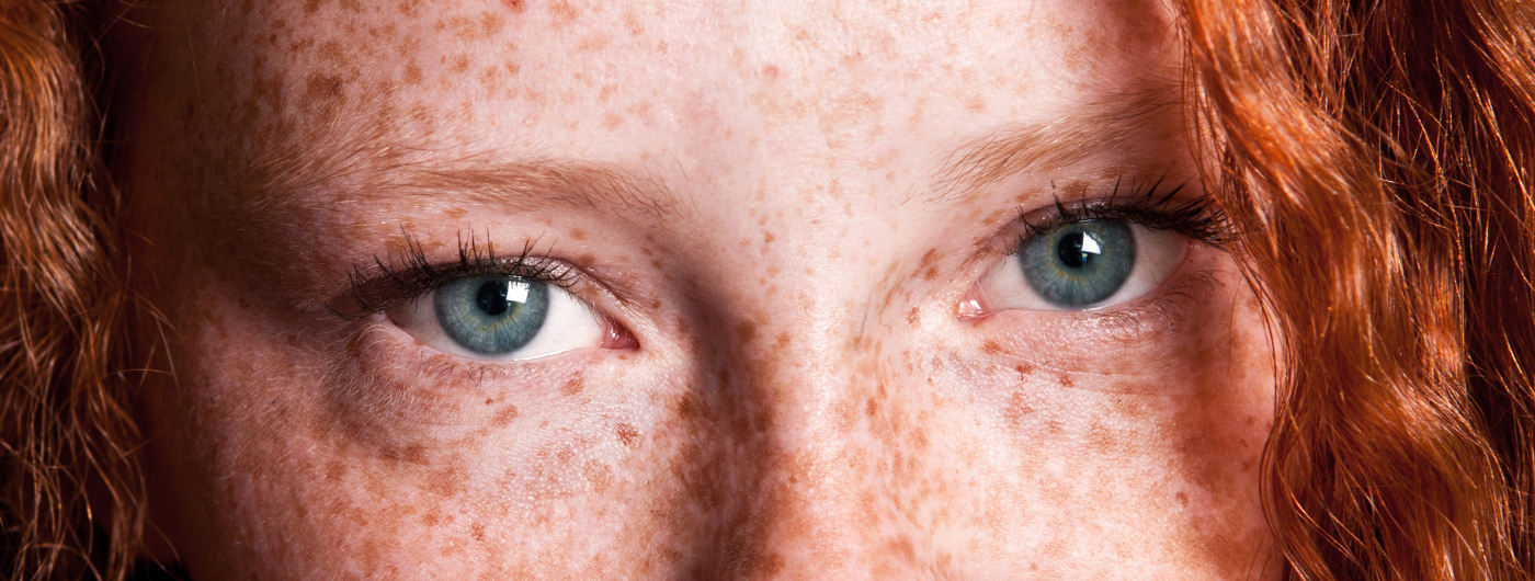 Sardas, melasma e manchas solares: como diferenciar?