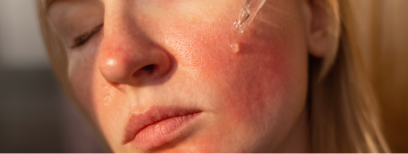Como recuperar a pele sensibilizada pelo uso de ácidos ou retinol?