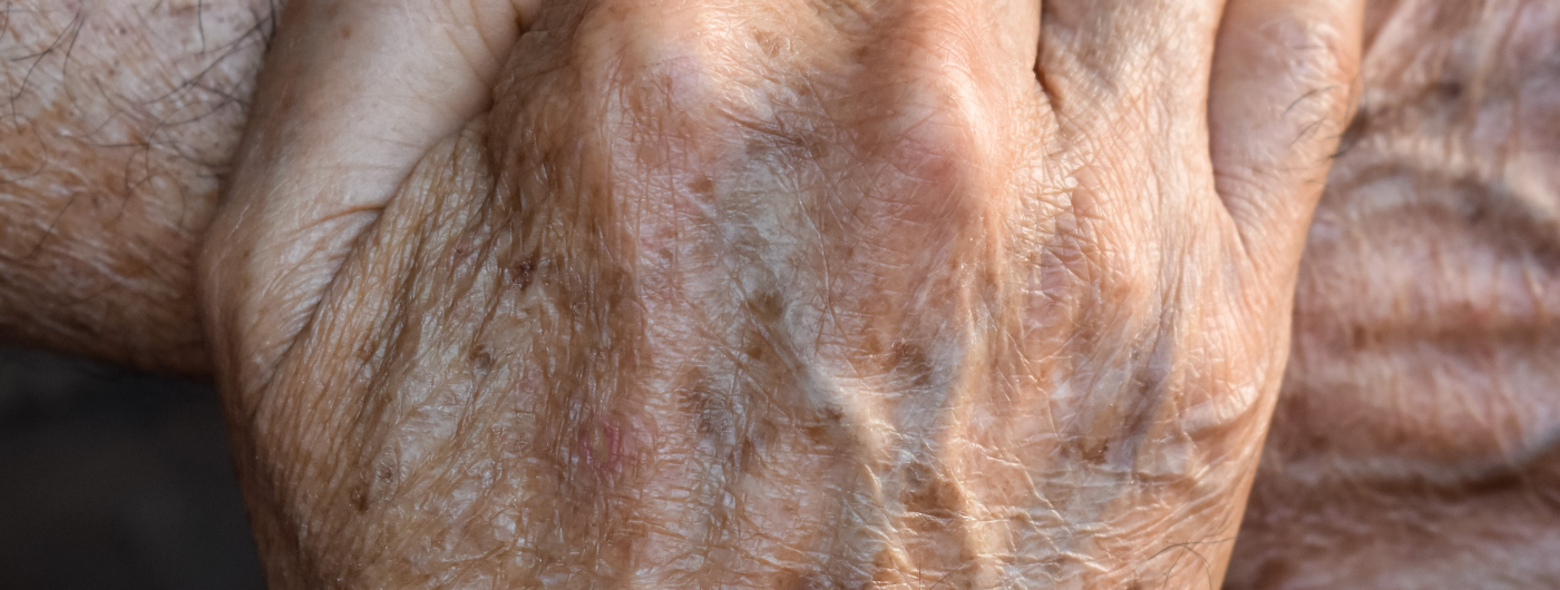 Diferença entre melasma e manchas de sol