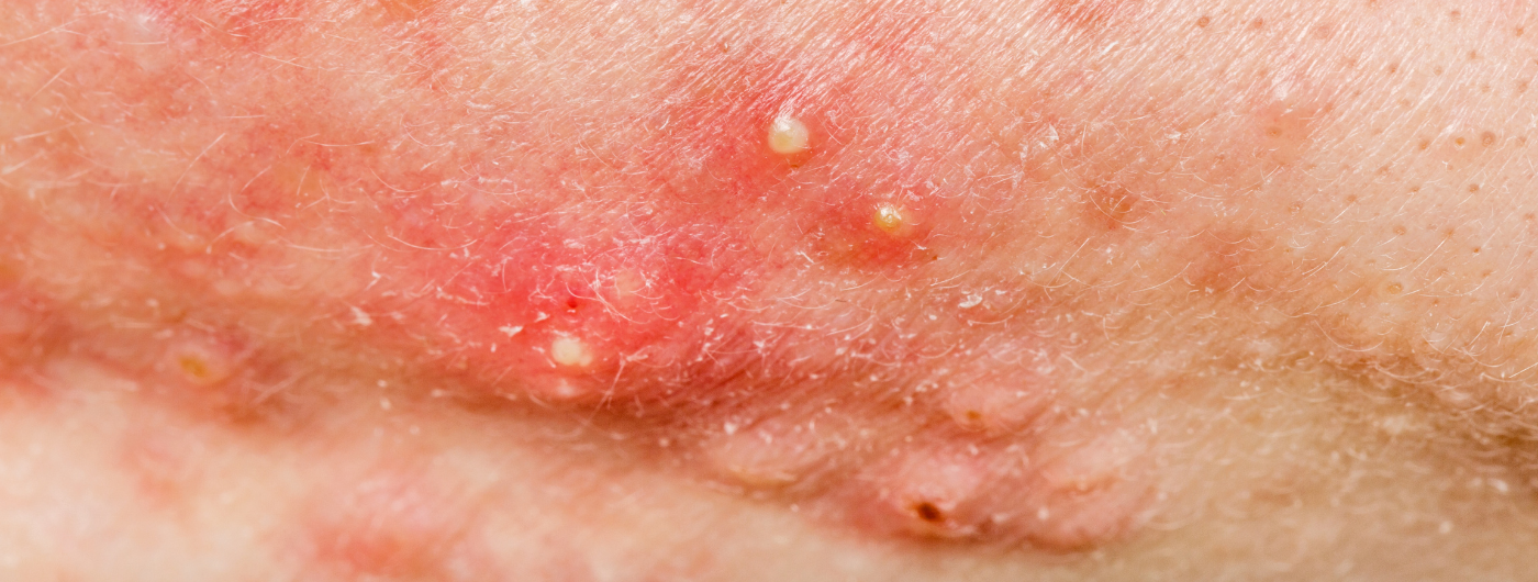 Manchas pós-acne: por que ficam marrons ou avermelhadas e como cuidar?