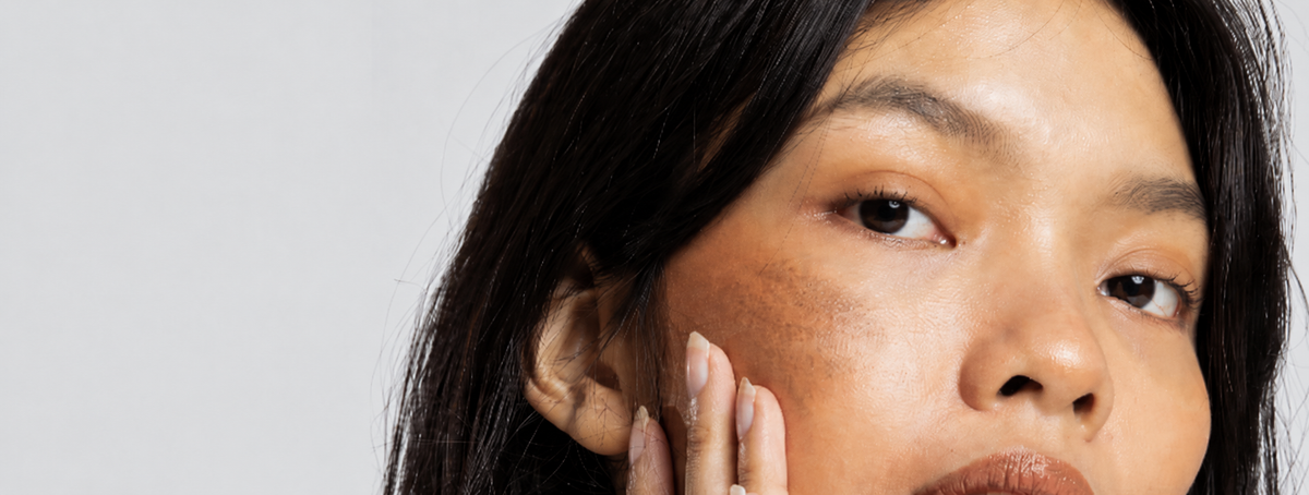 Melasma resistente: por que ele sempre volta?