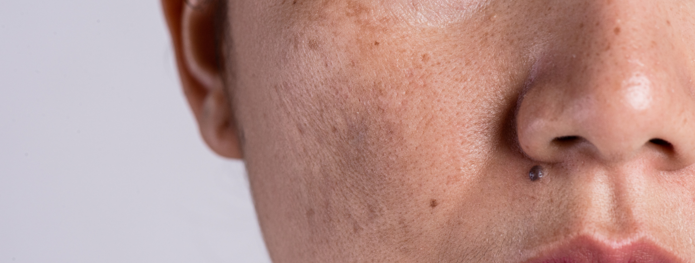 Melhores estratégias para prevenir o surgimento de novas manchas