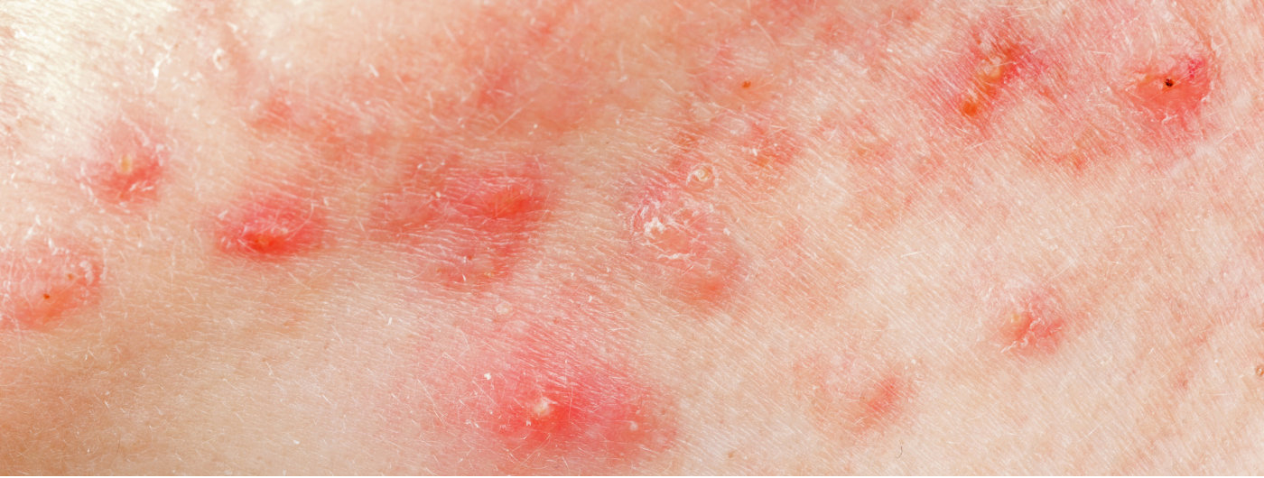 O Alfa-Arbutin funciona para clarear manchas de acne?