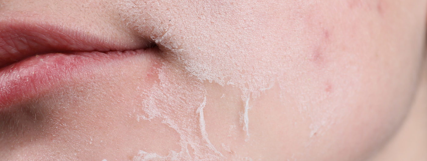 O que passar na pele irritada por ácidos, retinol ou procedimentos?