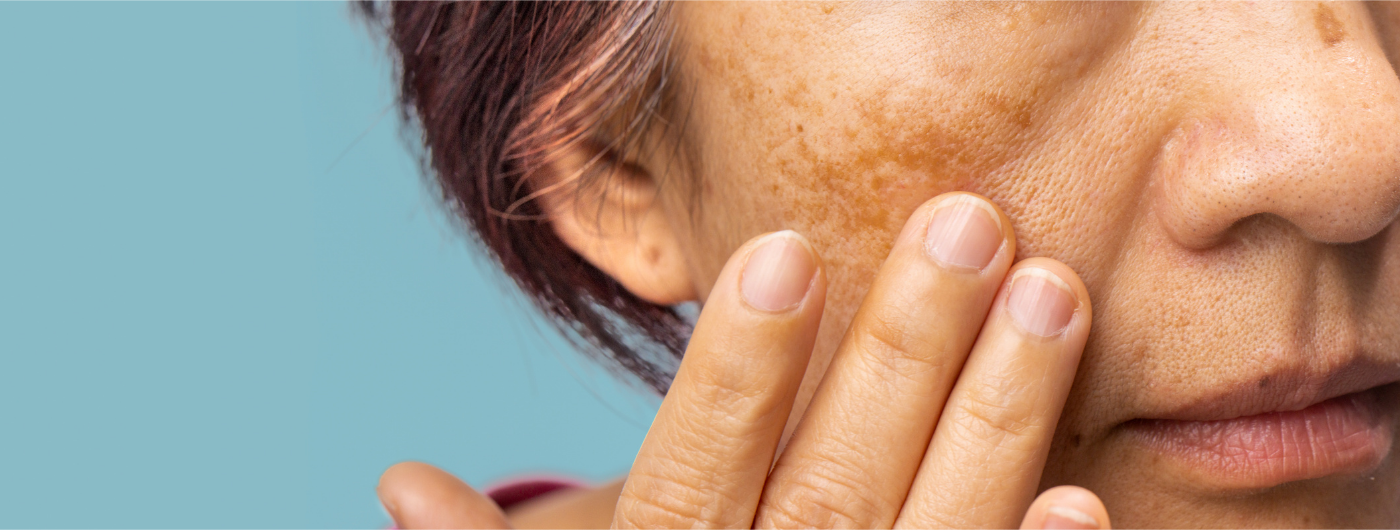 Luz visível, calor e radiação: o que pode piorar o melasma?