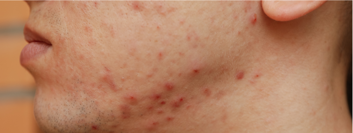 O que são manchas por inflamação da pele (HPI)?