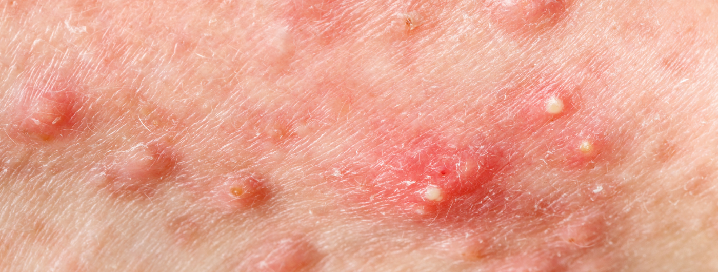 Por que a acne adulta exige uma rotina diferente da pele adolescente?