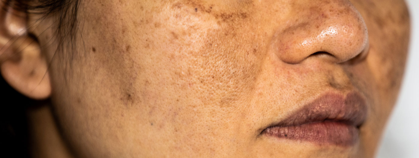 Tipos de melasma: como identificar cada grau?