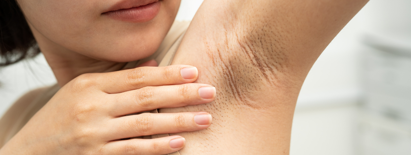 Por que as axilas escurecem e como clarear?