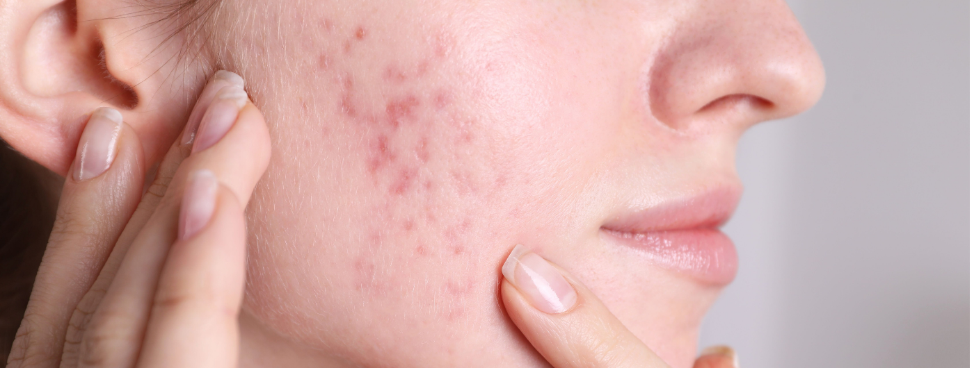 Como clarear manchas de espinhas rápido?