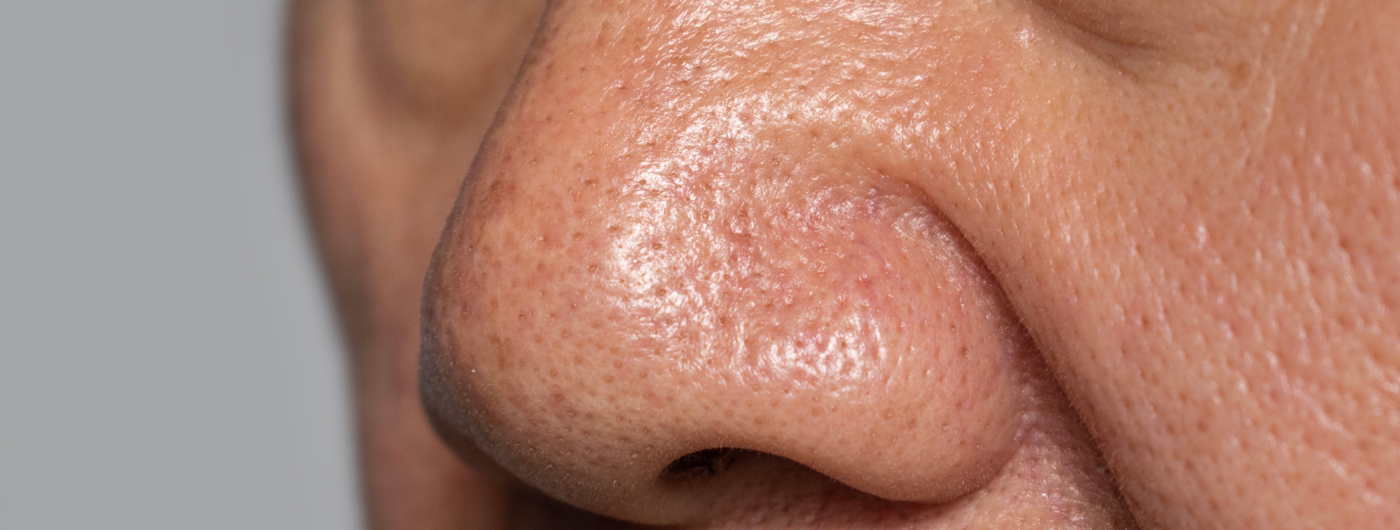 Como fechar os poros dilatados?