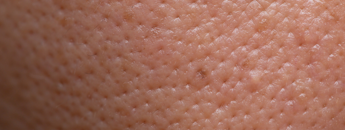 Como fechar os poros dilatados?