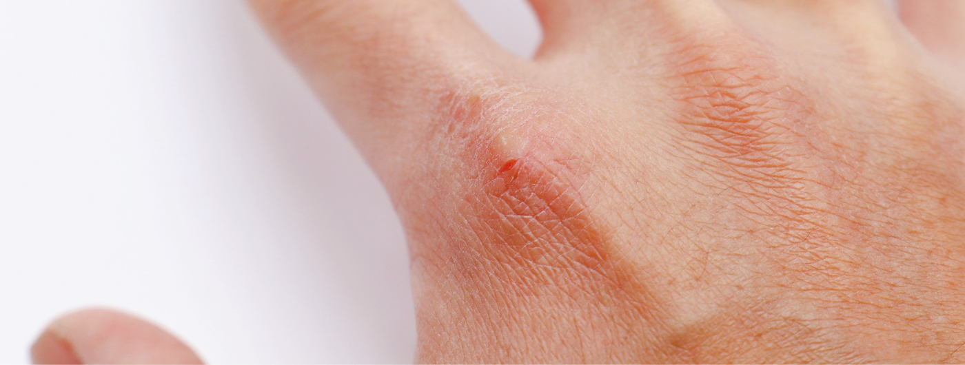 Como proteger a pele do ressecamento causado pelo frio?