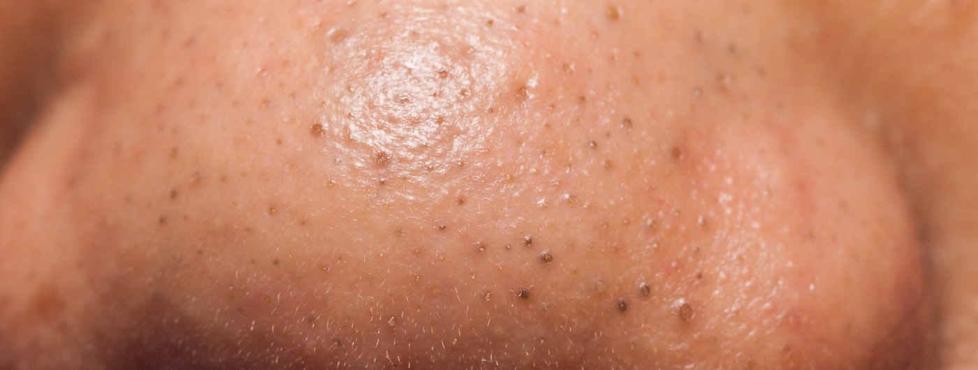 Como tirar cravos do nariz?