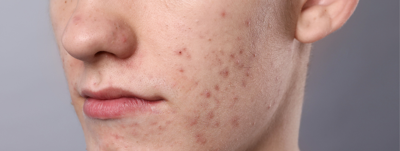 Em quanto tempo o Ácido Azelaico clareia manchas pós-inflamatórias?