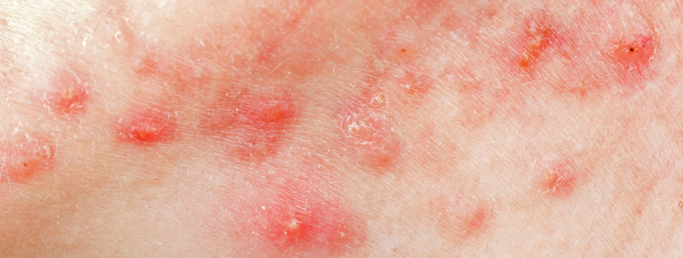 Pode espremer espinha? Como evitar cicatrizes e manchas?