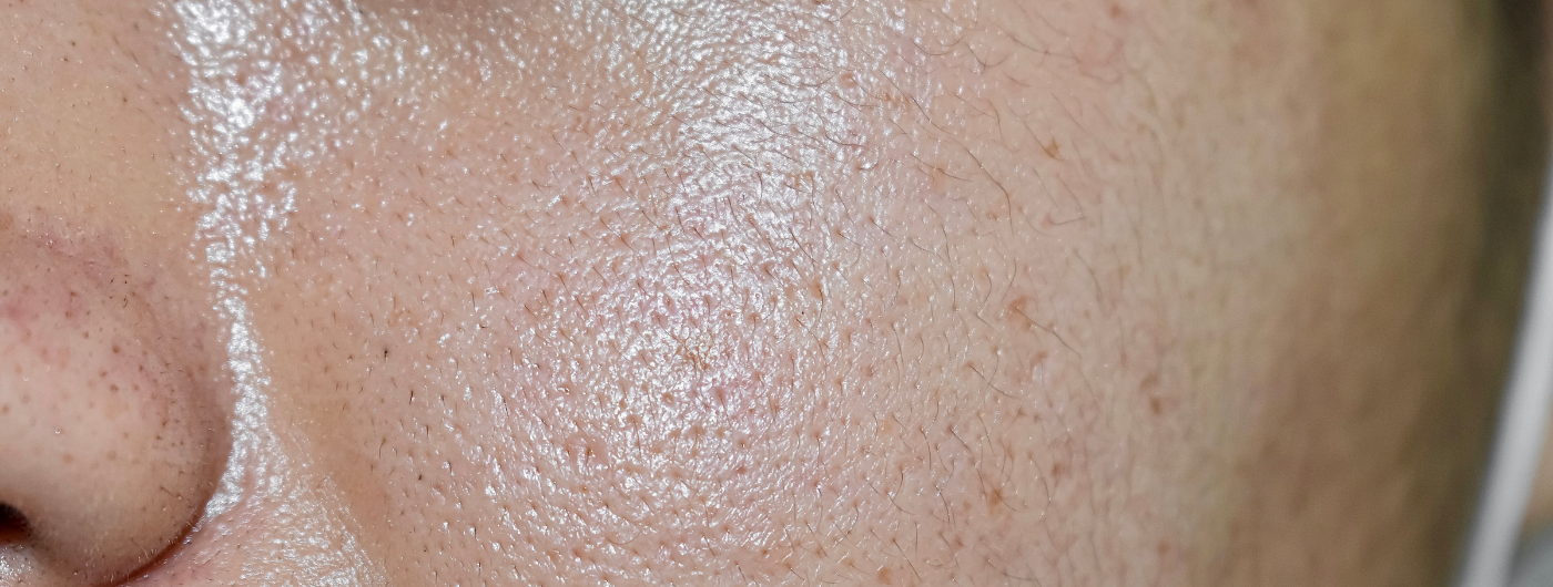 5 hábitos que pioram a oleosidade da pele