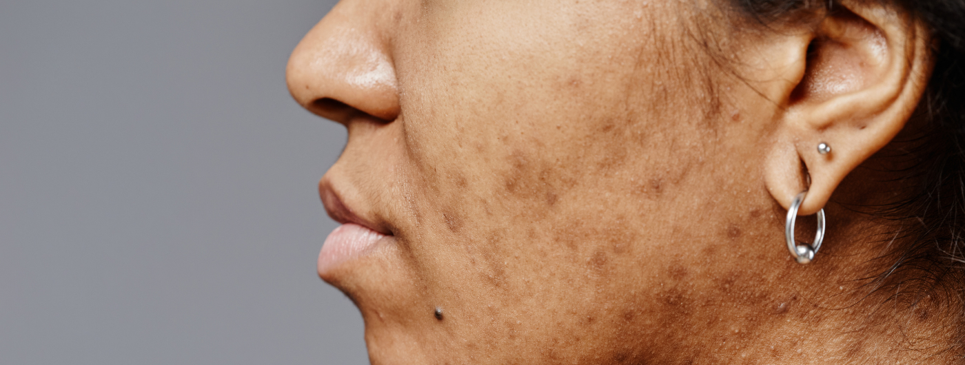 Por que surgem manchas escuras na pele após a acne?