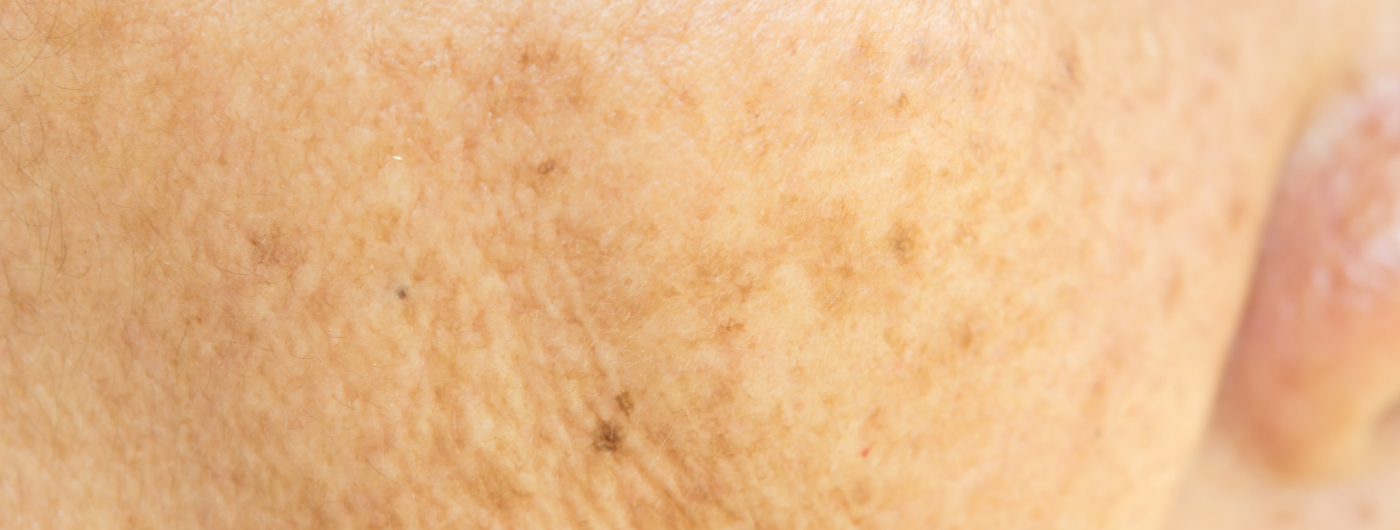 Melasma: O que é e qual o melhor tratamento?