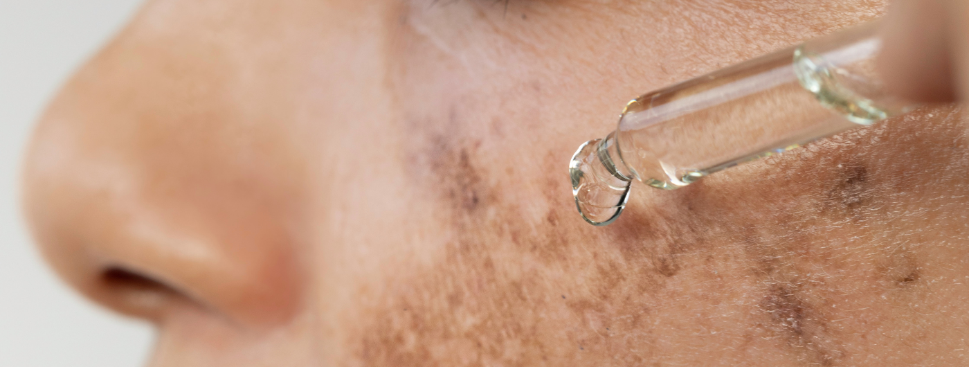 Melasma tem tratamento definitivo?